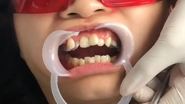 [LIVESTREAM]: Niềng răng mắc cài kim loại điều trị răng MÓM
 KHẤP KHỂNH