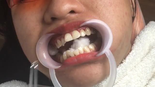 LIVESTREAM: Niềng răng mắc cài kim loại thường điều trị răng HÔ  KHẤP KHỂNH