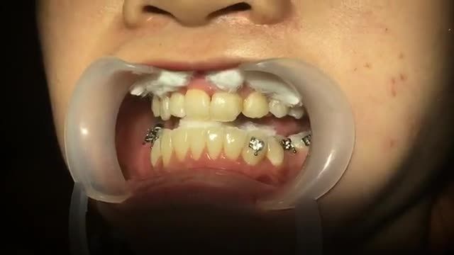 LIVESTREAM: GẮN 2 case cùng lúc tại Nha Khoa Vân Anh
case ngày 11/8/2019