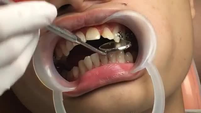 LIVESTREAM]: Niềng răng mắc cài kim loại tự buộc điều trị răng VẨU  THƯA