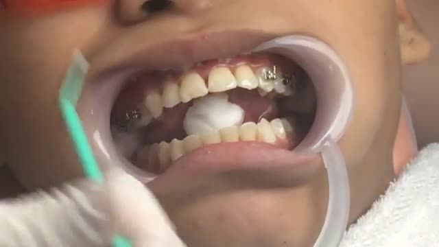 LIVESTREAM: NIỀNG RĂNG 3 NĂM CHƯA THÁO
NIỀNG LẠI TẠI NHA KHOA VÂN ANH