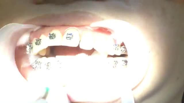 [LIVESTREAM]: GẮN 3 CA GẮN MẮC CÀI CÙNG LÚC tại Nha Khoa Vân Anh