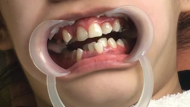 [LIVESTREAM]: Mỗi ngày 1 ca trồng răng IMPLANT