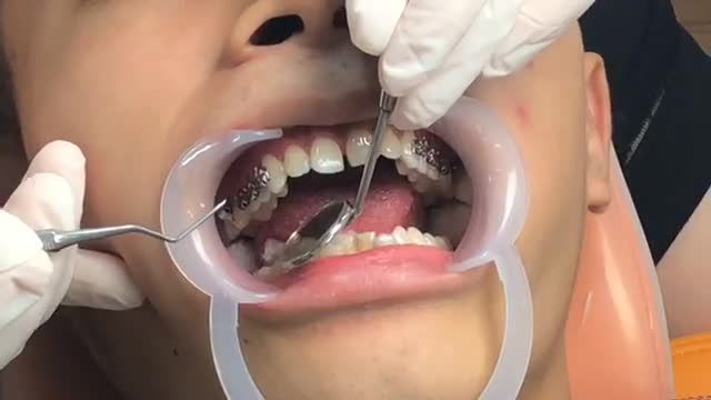 [LIVESTREAM]: Niềng răng mắc cài kim loại điều trị răng THƯA
+ KHẤP KHỂNH