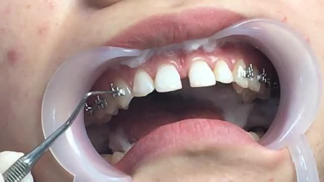 [LIVESTREAM]: GẮN MẮC CÀI - NIỀNG RĂNG ĐIỀU TRỊ RĂNG THƯA CHÌA 2 hàm