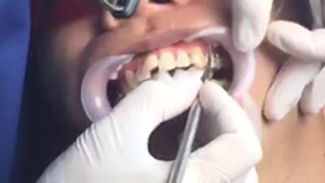 LIVESTREAM: Niềng răng mắc cài kim loại điều trị răng KHẤP KHỂNH