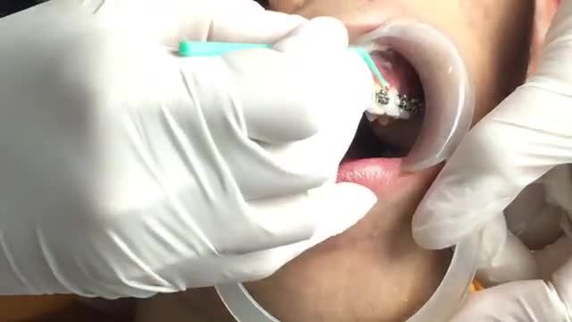 LIVESTREAM: Niềng răng mắc cài kim loại điều trị răng HÔ 
case số 1ngày 7/8/2019