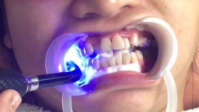 LIVESTREAM: Niềng răng mắc cài sứ tự buộc điều trị răng MÓM+ KHẤP KHỂNH