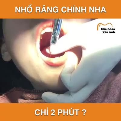 NHỔ RĂNG TRONG CHỈNH NHA - CÓ ĐÁNG SỢ NHƯ BẠN NGHĨ