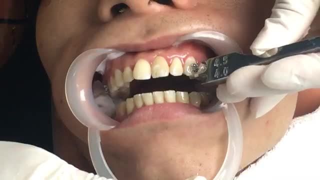 LIVESTREAM: Niềng răng mắc cài kim loại tự buộc điều trị răng HÔ