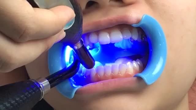 LIVESTREAM: Niềng răng mắc cài kim loại tự buộc điều trị răng KHẤP KHỂNH