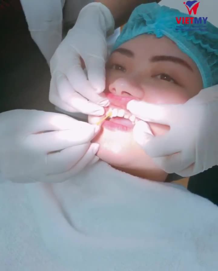 LỘT XÁC NGOẠN MỤC BẰNG CÔNG NGHỆ DÁN SỨ VENEER