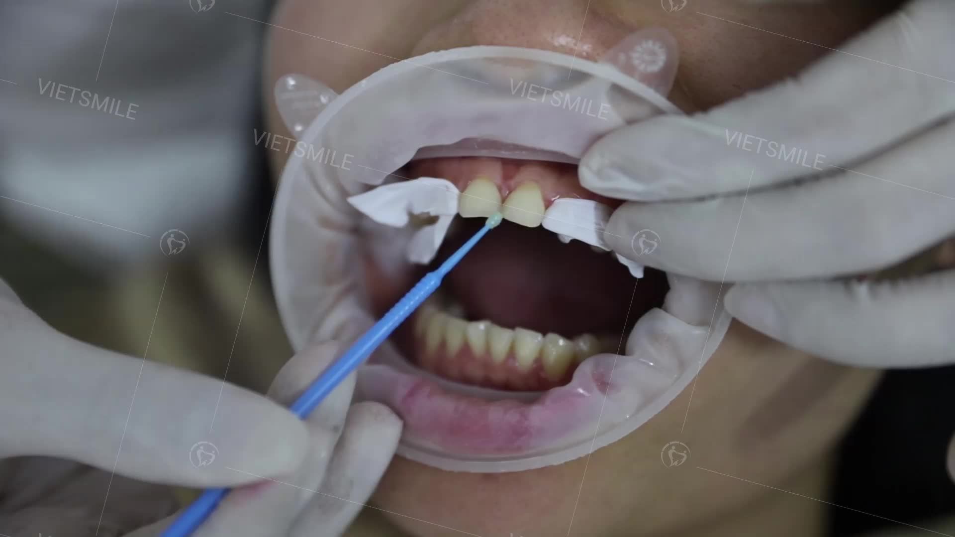 Dán sứ veneer không mài VIETSMILE