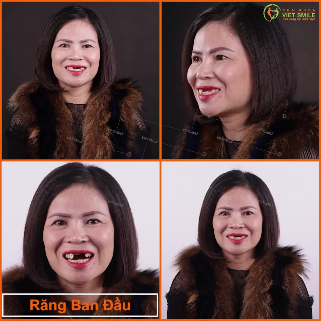 MỘT GƯƠNG MẶT 2 SẮC THÁI - NỤ CƯỜI LÀM NÊN SỰ KHÁC BIỆT