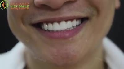 bọc sứ Việt Smile