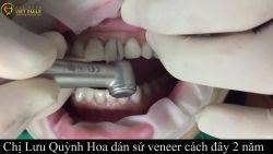CẬN CẢNH THÁO MIẾNG DÁN SỨ VENEER
BẤT NGỜ VÔ CÙNG VỚI RĂNG GỐC