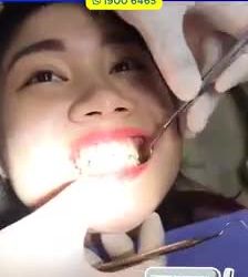 CẬN CẢNH QUÁ TRÌNH LẤY DẤU RĂNG BẰNG MÁY ITERO TRONG NIỀNG RĂNG INVISALIGN