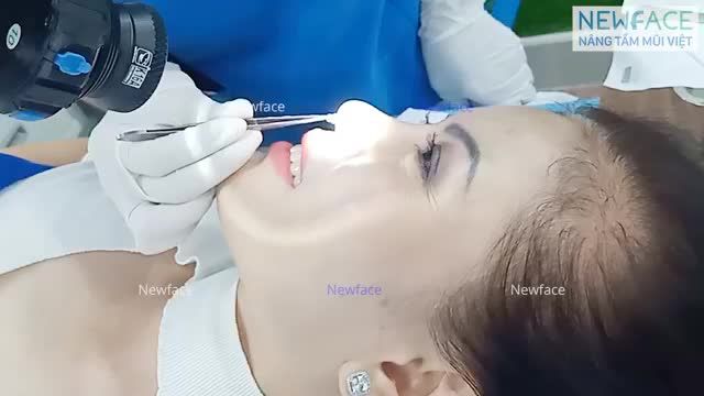 Chị khách Việt kiều Mỹ thỏa ước nguyện có được chiếc mũi đẹp tự nhiên sau mấy chục năm ấp ủ