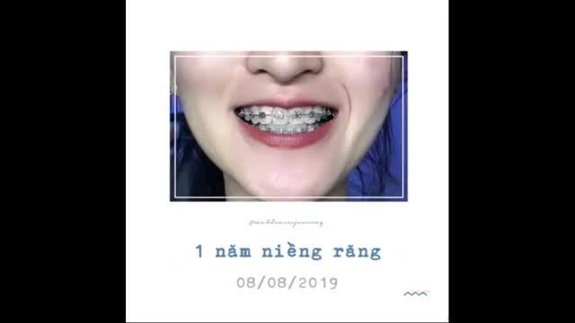 HÀNH TRÌNH 1 NĂM NIỀNG RĂNG