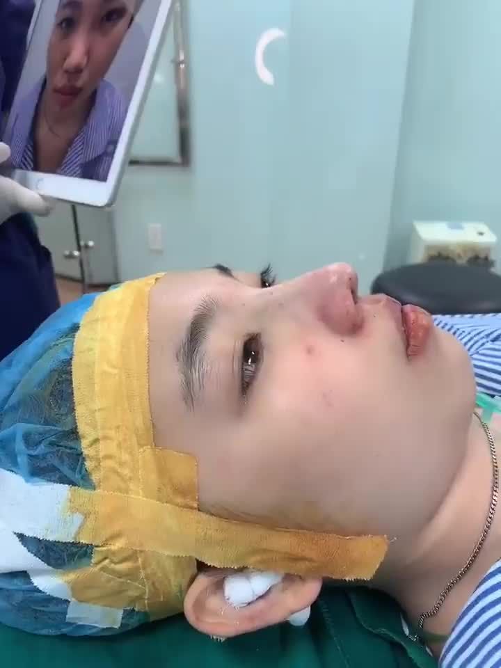 Nâng mũi cấu trúc + cắt môi tim