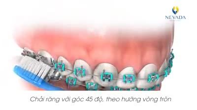 HƯỚNG DẪN VỆ SINH RĂNG KHI NIỀNG