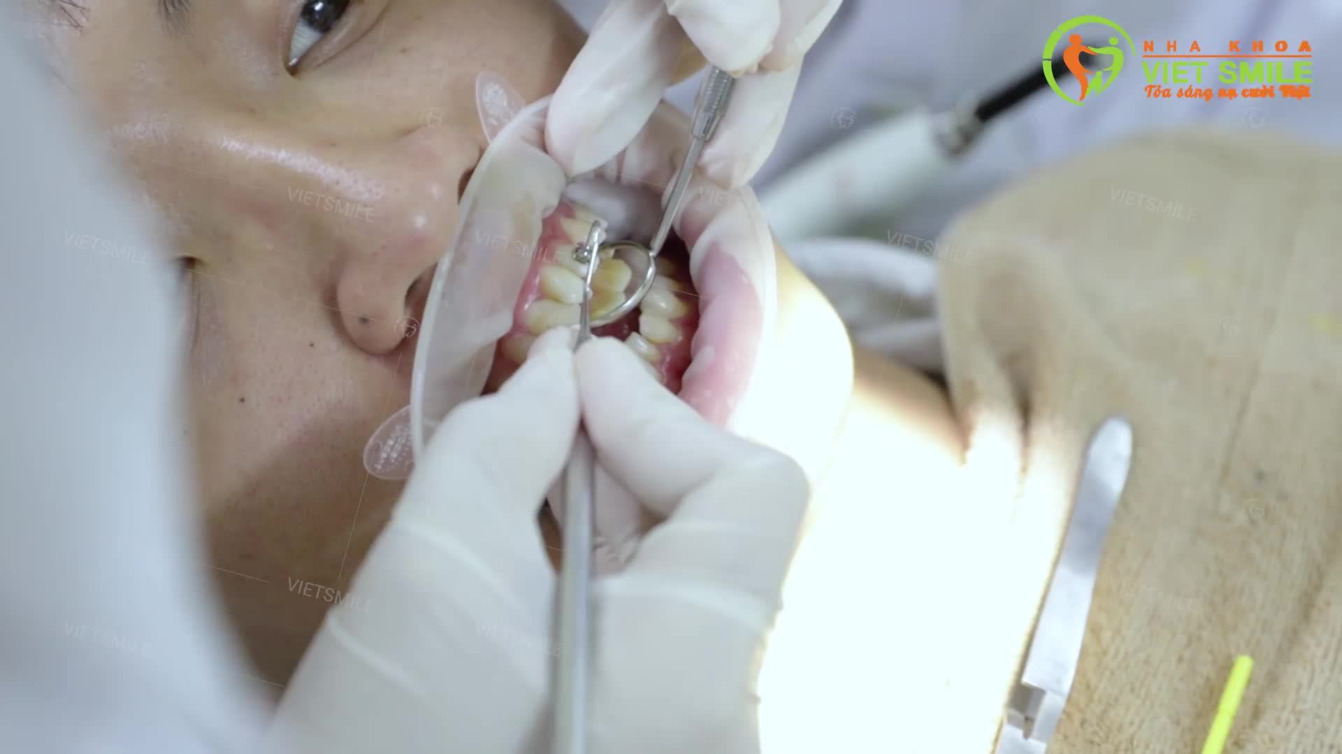 NIỀNG RĂNG - ĐẦU TƯ THÔNG MINH - CHINH PHỤC LỢI ÍCH