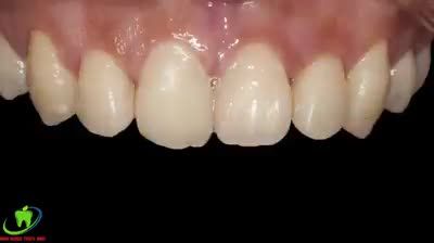 PHẪU THUẬT CƯỜI HỞ LỢI BIẾT TRƯỚC KẾT QUẢ.