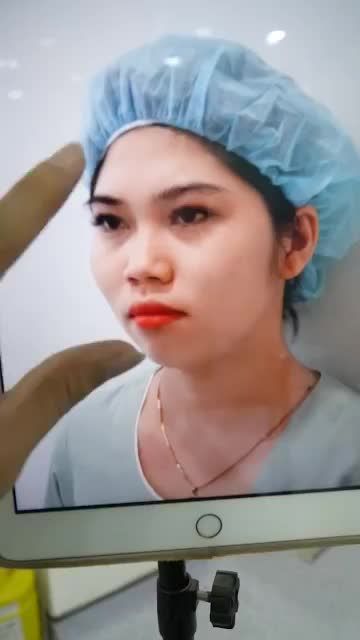 KHÁCH HÀNG VỪA THỰC HIỆN XONG NÂNG MŨI CẤU TRÚC - ĐẸP MỌI GÓC NHÌN, MŨI CAO THANH TÚ