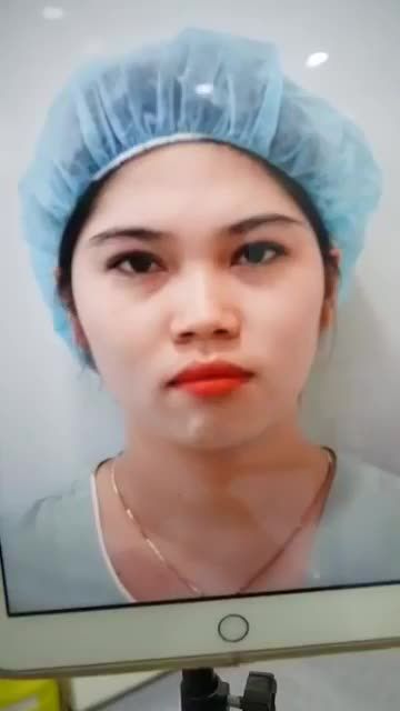 KHÁCH HÀNG VỪA THỰC HIỆN XONG NÂNG MŨI CẤU TRÚC - ĐẸP MỌI GÓC NHÌN, MŨI CAO THANH TÚ