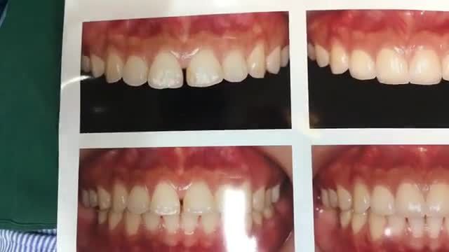 gắn 4 răng sứ thẩm mỹ, thay đổi nụ cười cho bạn Lan - Phổ Yên