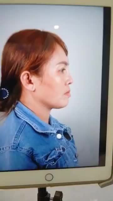 THÊM 1 CASE NÂNG MŨI CẤU TRÚC VỪA THỰC HIỆN XONG TẠI DR HOẠT