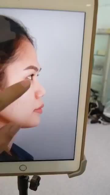 NÂNG MŨI CẤU TRÚC VỪA THỰC HIỆN XONG