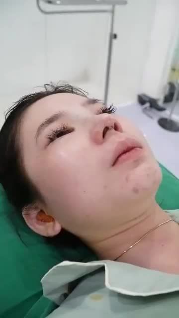 DÁNG MŨI CẤU TRÚC CAO THON VỪA THỰC HIỆN XONG TẠI DR HOẠT