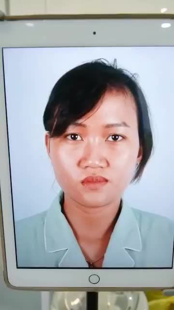 DR HOẠT VỪA HOÀN THÀNH XONG CA NÂNG MŨI CẤU TRÚC DÁNG CAO THON