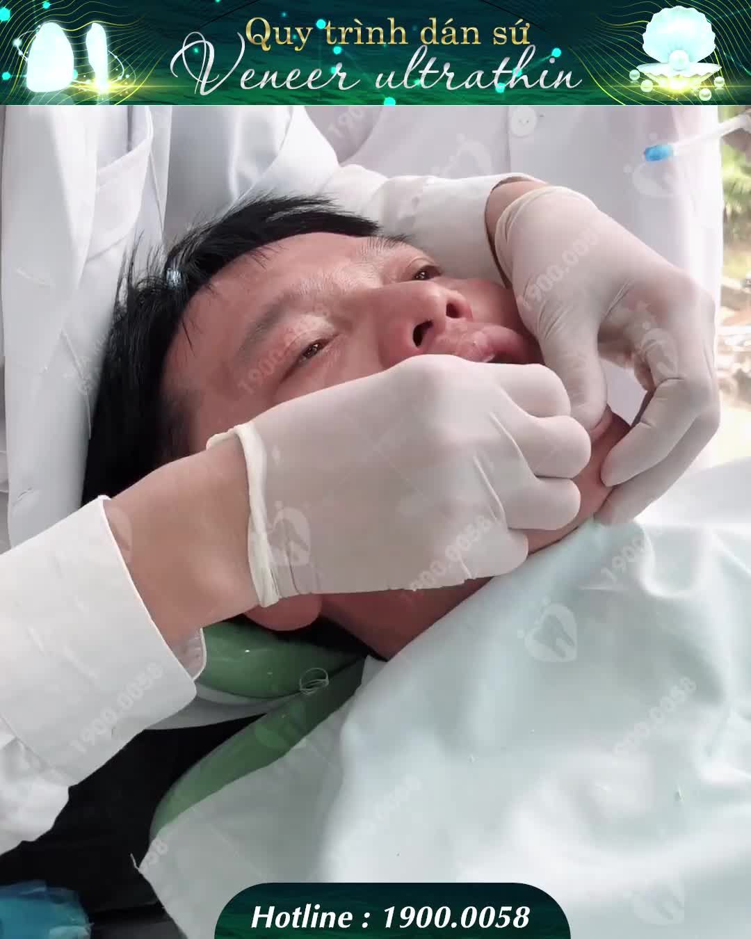 DÁN SỨ VENEER SIÊU MỎNG – THẨM MỸ RĂNG VƯỢT TRỘI NHẤT 2019