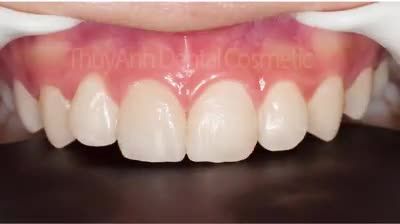 NHA KHOA THÙY ANH - NƠI NỤ CƯỜI ĐƯỢC TỎA SÁNG