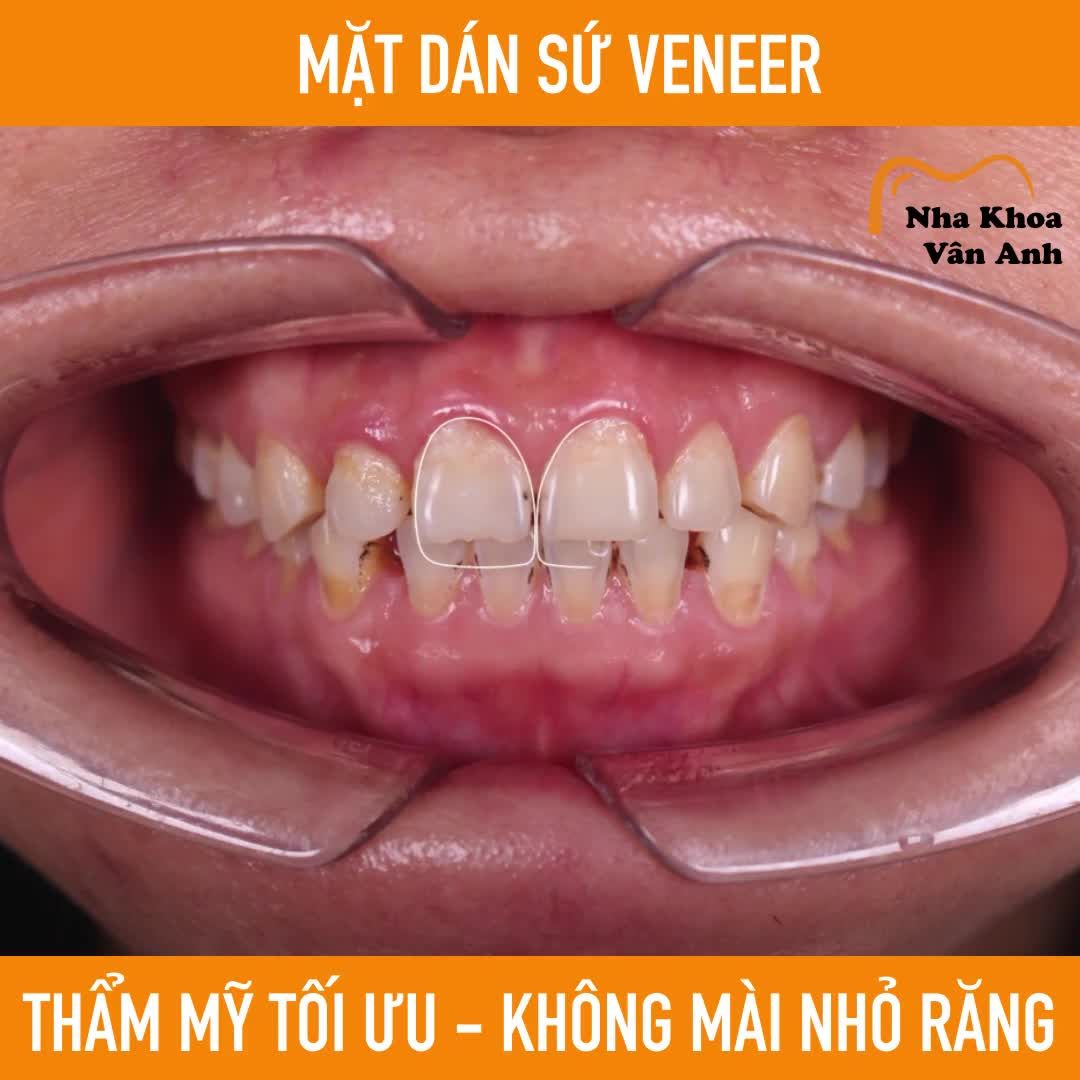 Mặt dán sứ VENEER là phương pháp làm răng thẩm mỹ tốt nhất, an toàn nhất hiện nay