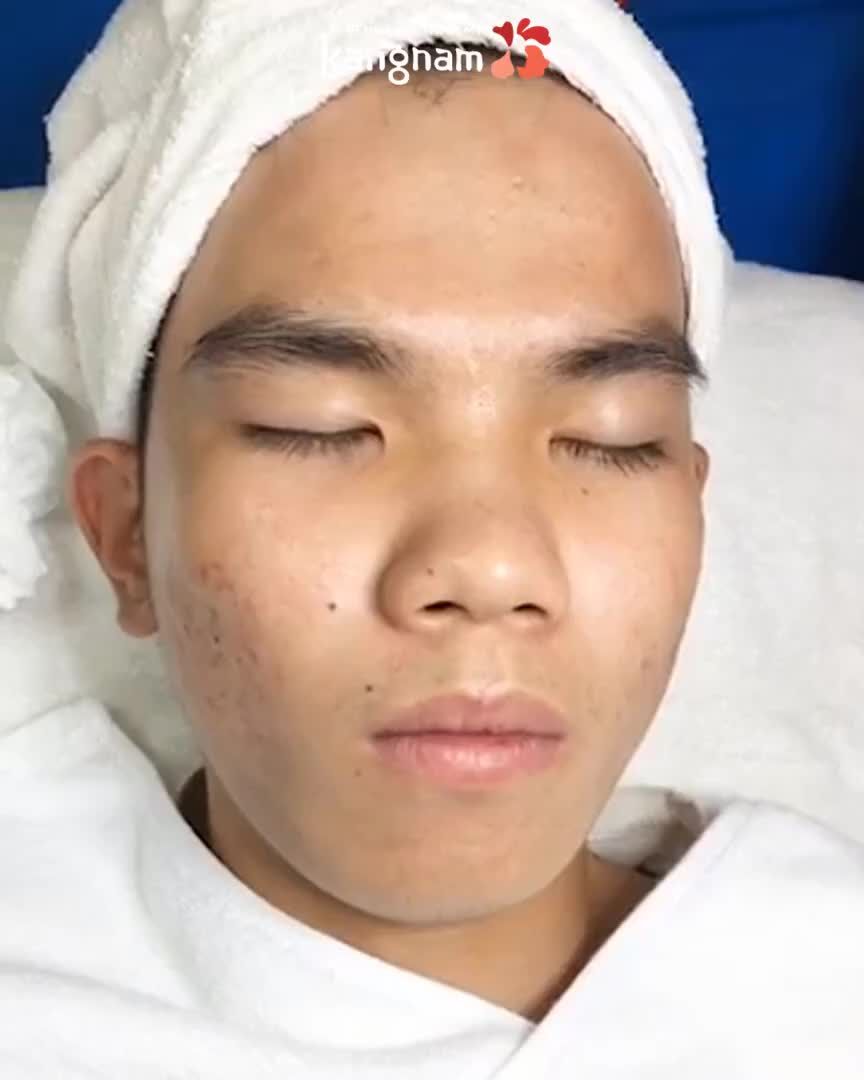 Chàng trai 2 năm đi chữa mụn khắp nơi không khỏi