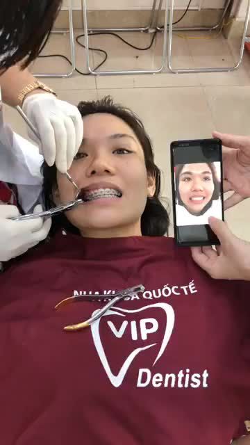 Cùng Vip Dentist theo dõi cận cảnh case tháo mắc cài thứ 2 trong ngày