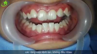 NIỀNG RĂNG - SỰ LỰA CHỌN HOÀN HẢO CHO NỤ CƯỜI CỦA BẠN