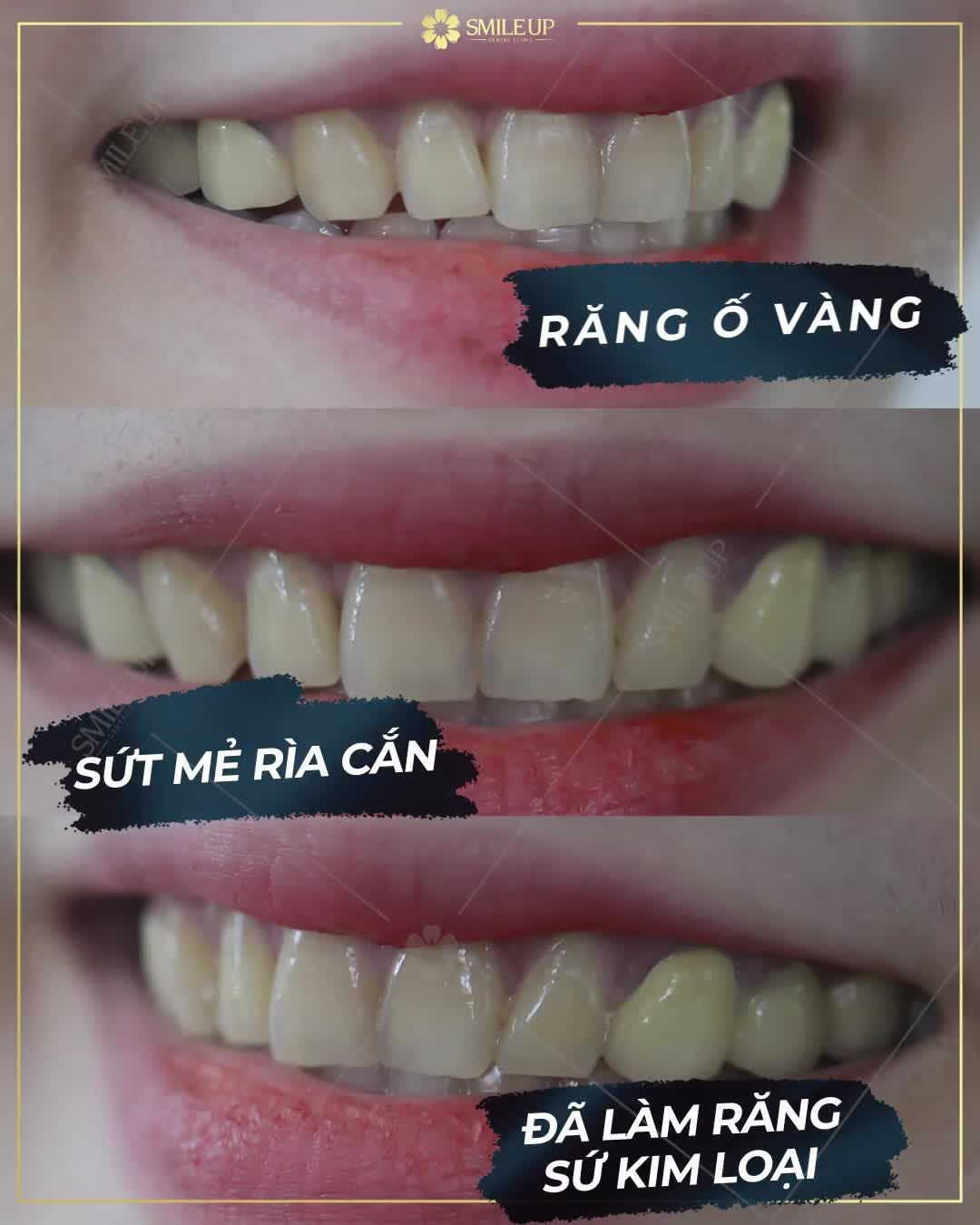 THAY ĐỔI CẢ GƯƠNG MẶT CHỈ VÌ LÀM RĂNG SỨ..!
