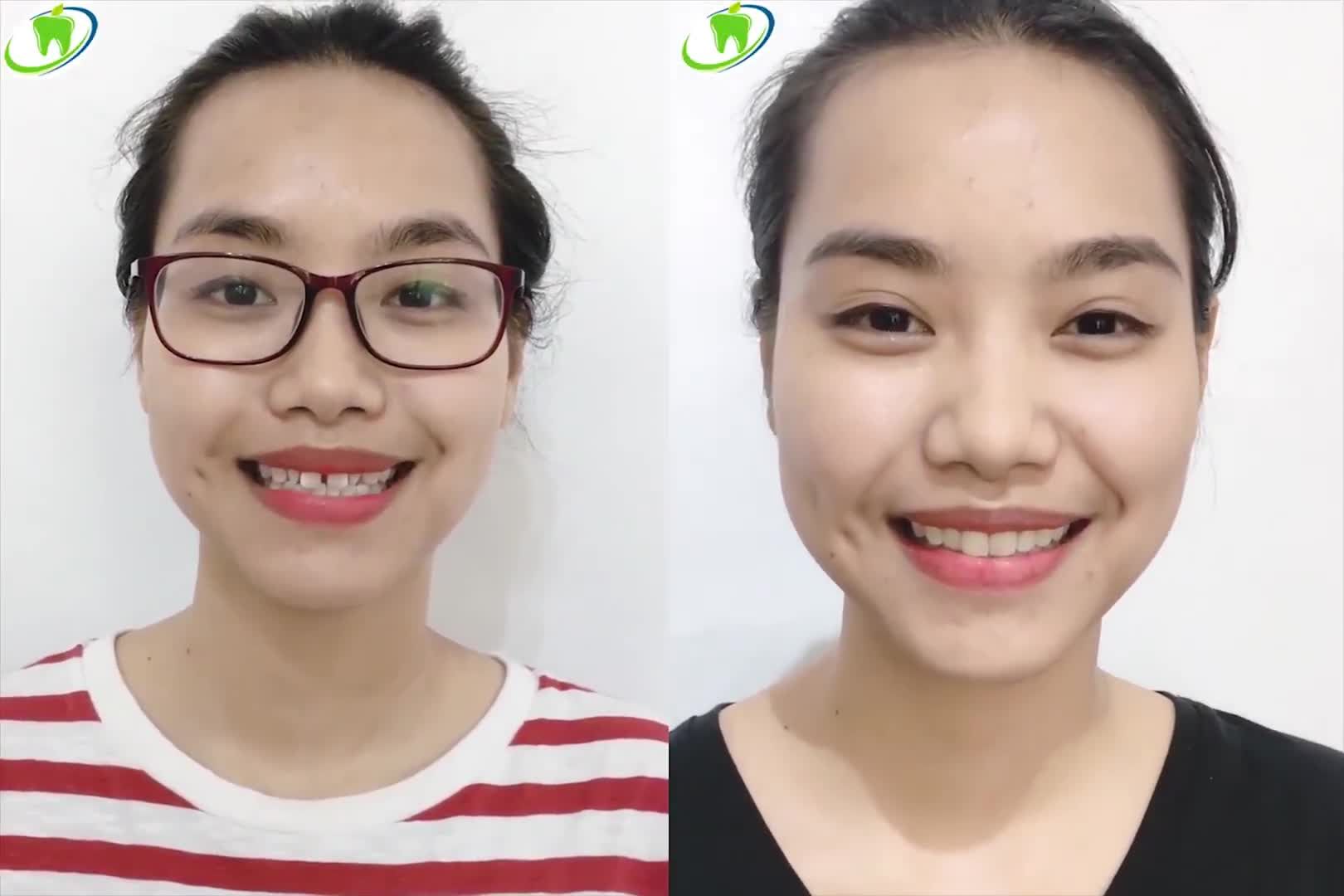 Cười tự tin sau khi làm răng tại Nha Khoa Thùy Anh.