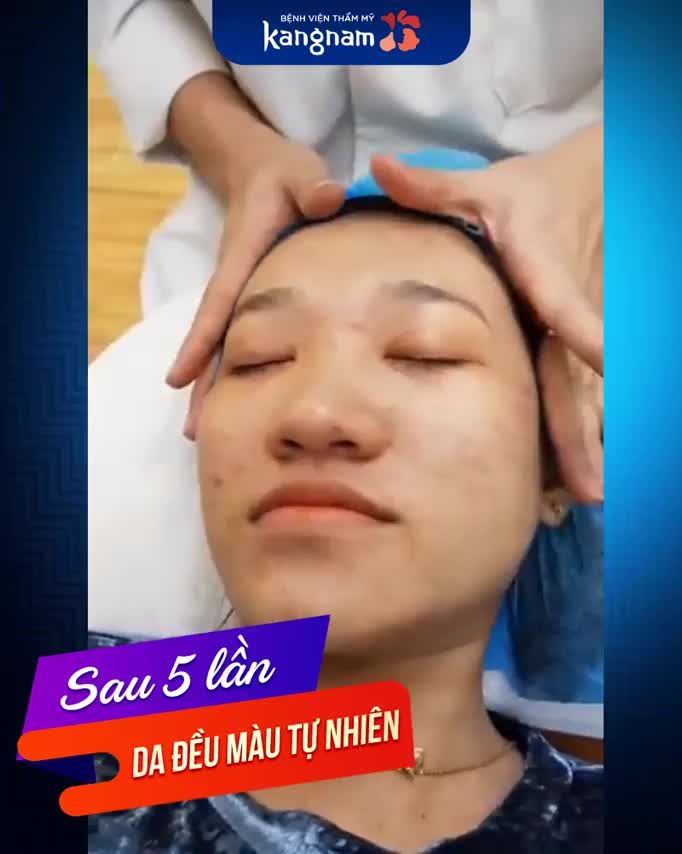 Sẹo thâm, sẹo lõm nghiêm trọng