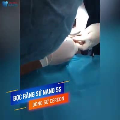 Trực Tiếp Bọc Răng Sứ Phục Hình Răng Cửa Hình Thể Xấu