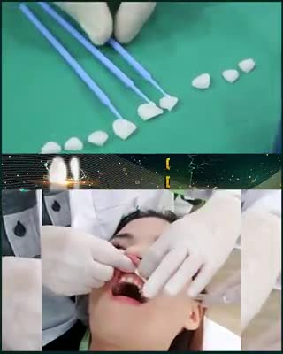 Theo dõi thao tác các bước dán sứ Veneer không ê buốt, không mài nhỏ răng tại ??? ???? ??? Đ?̀??.
