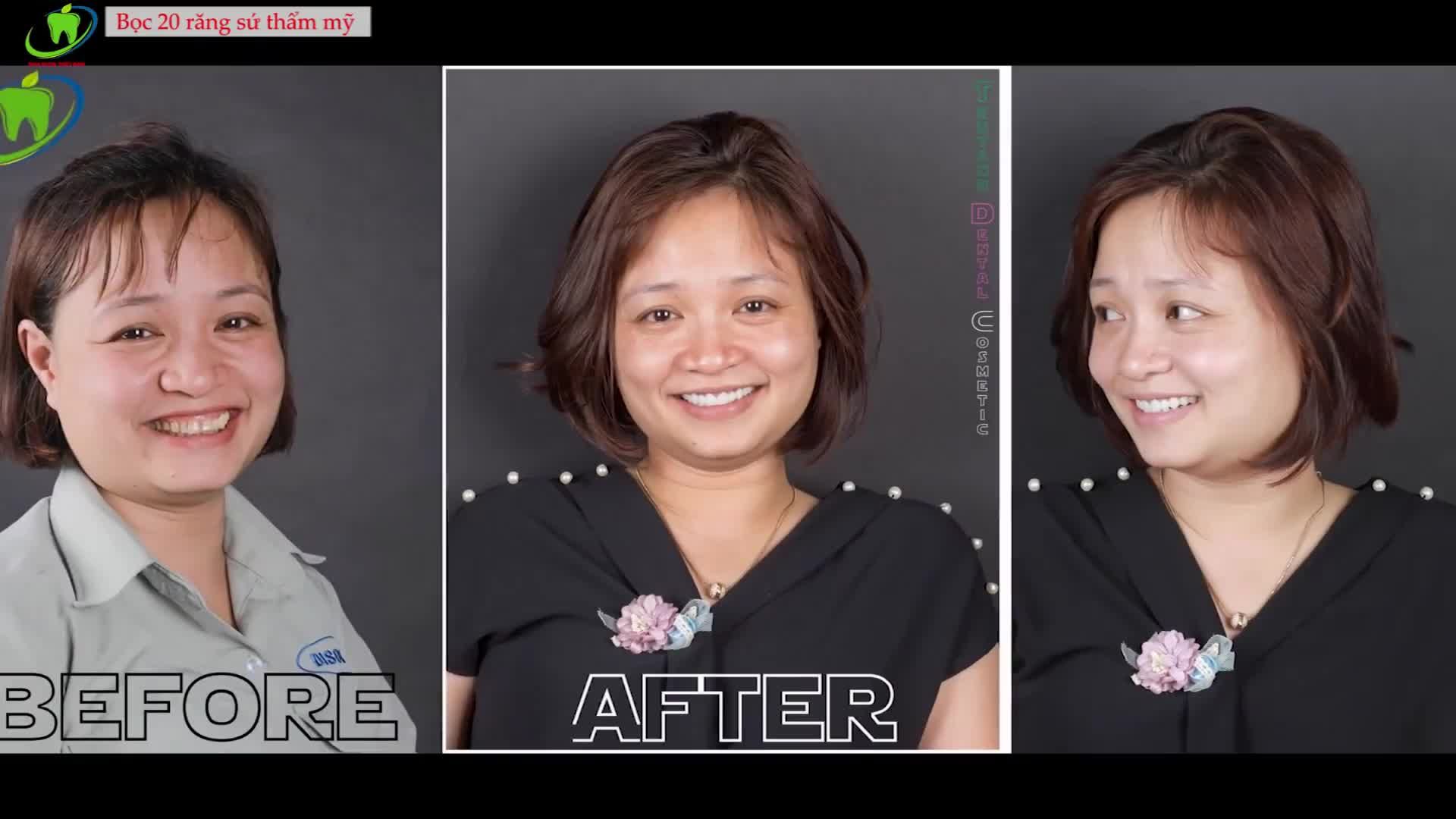 KHÔNG ĐAU KHÔNG MÀI NHỎ HÃY ĐẾN NHA KHOA THÙY ANH