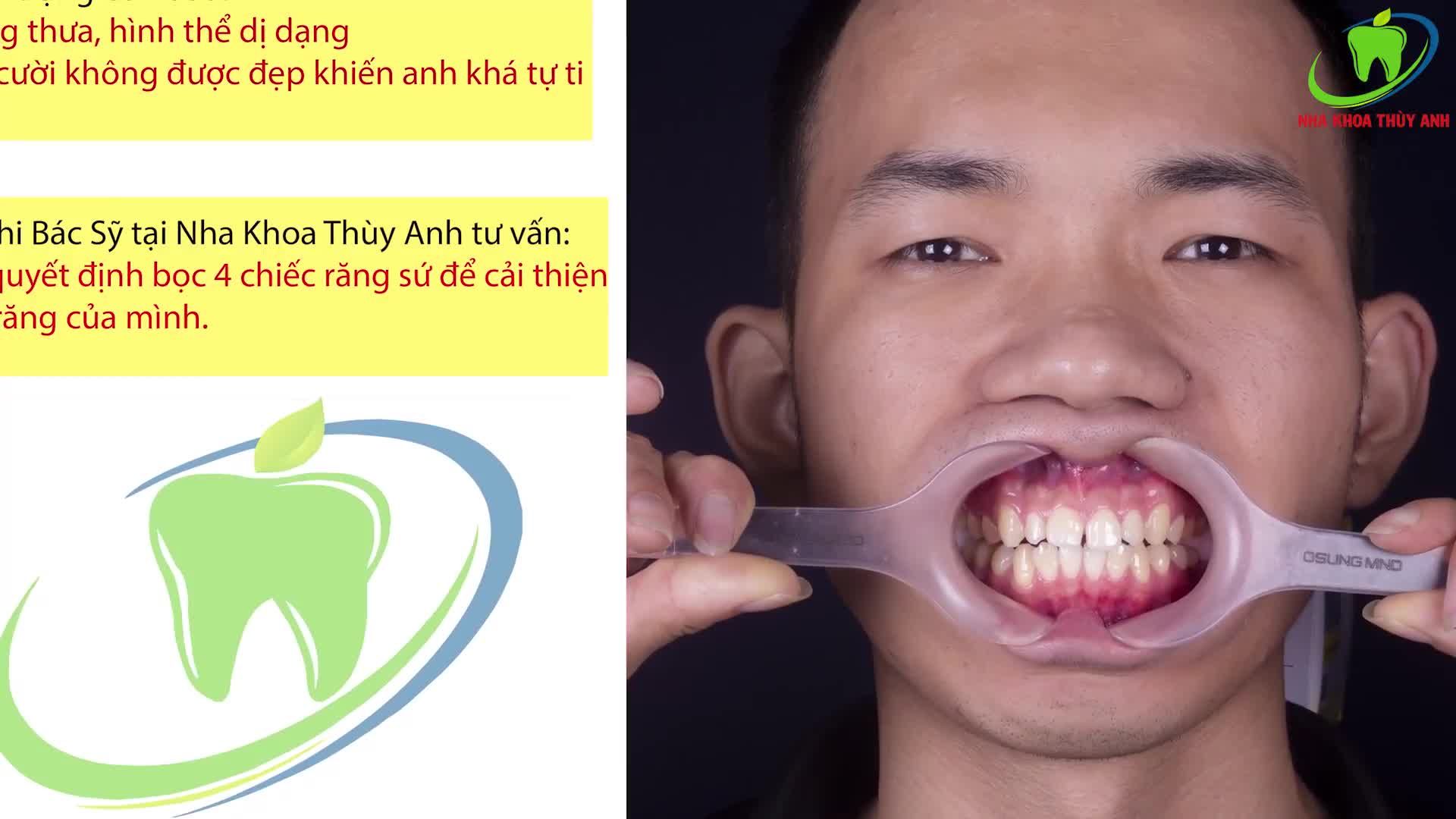 BỌC RĂNG SỨ THẨM MỸ - LẤY LẠI SỰ TỰ TIN CHO PHÁI MẠNH