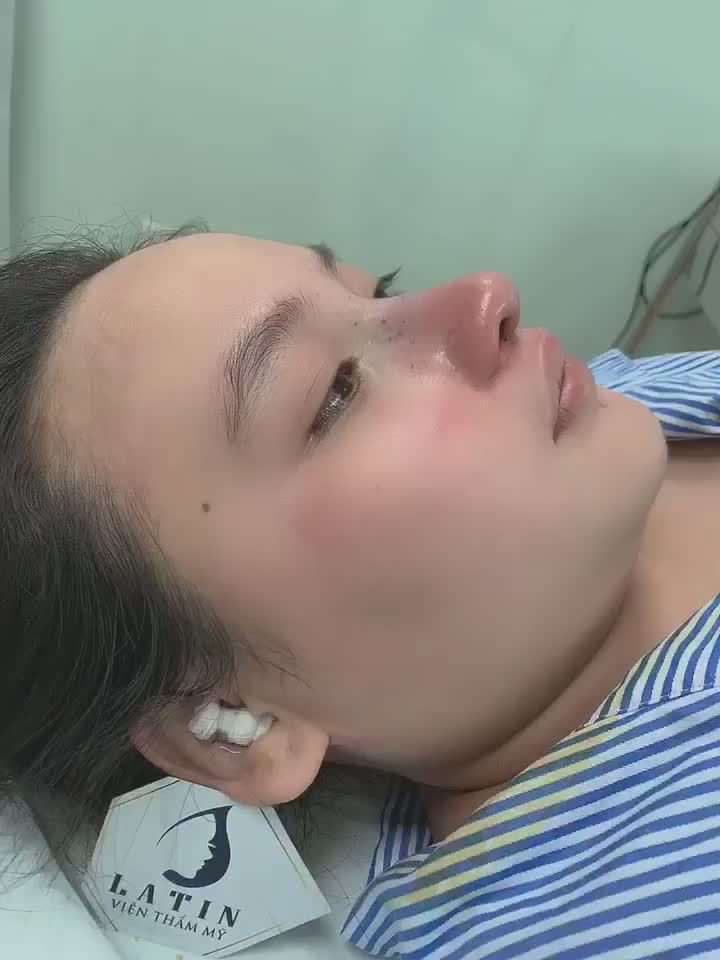 GIÁ GIẢM SÂU - MŨI ĐẸP THẦN SẦU