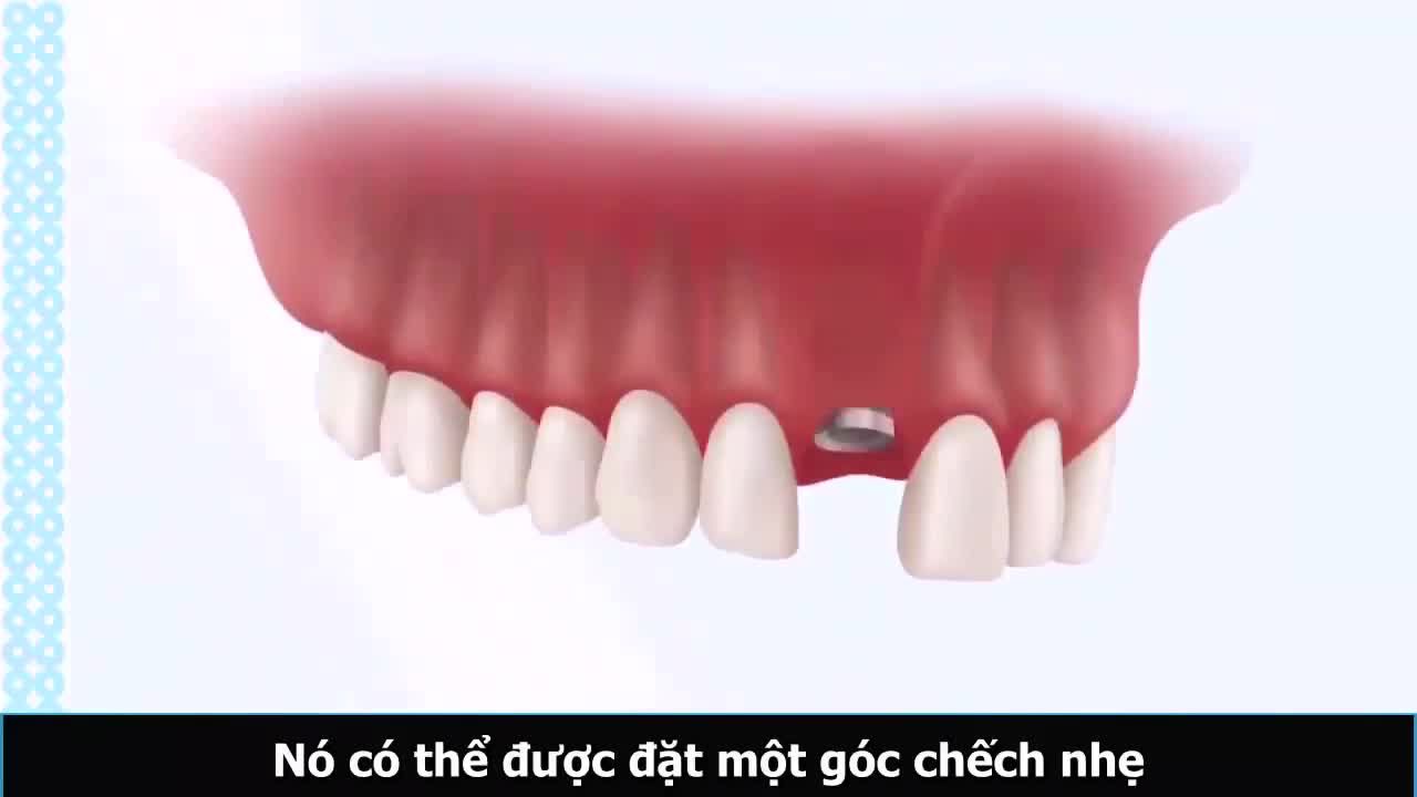 Implant là giải pháp tối ưu nhất cho người bị mất răng hiện nay.