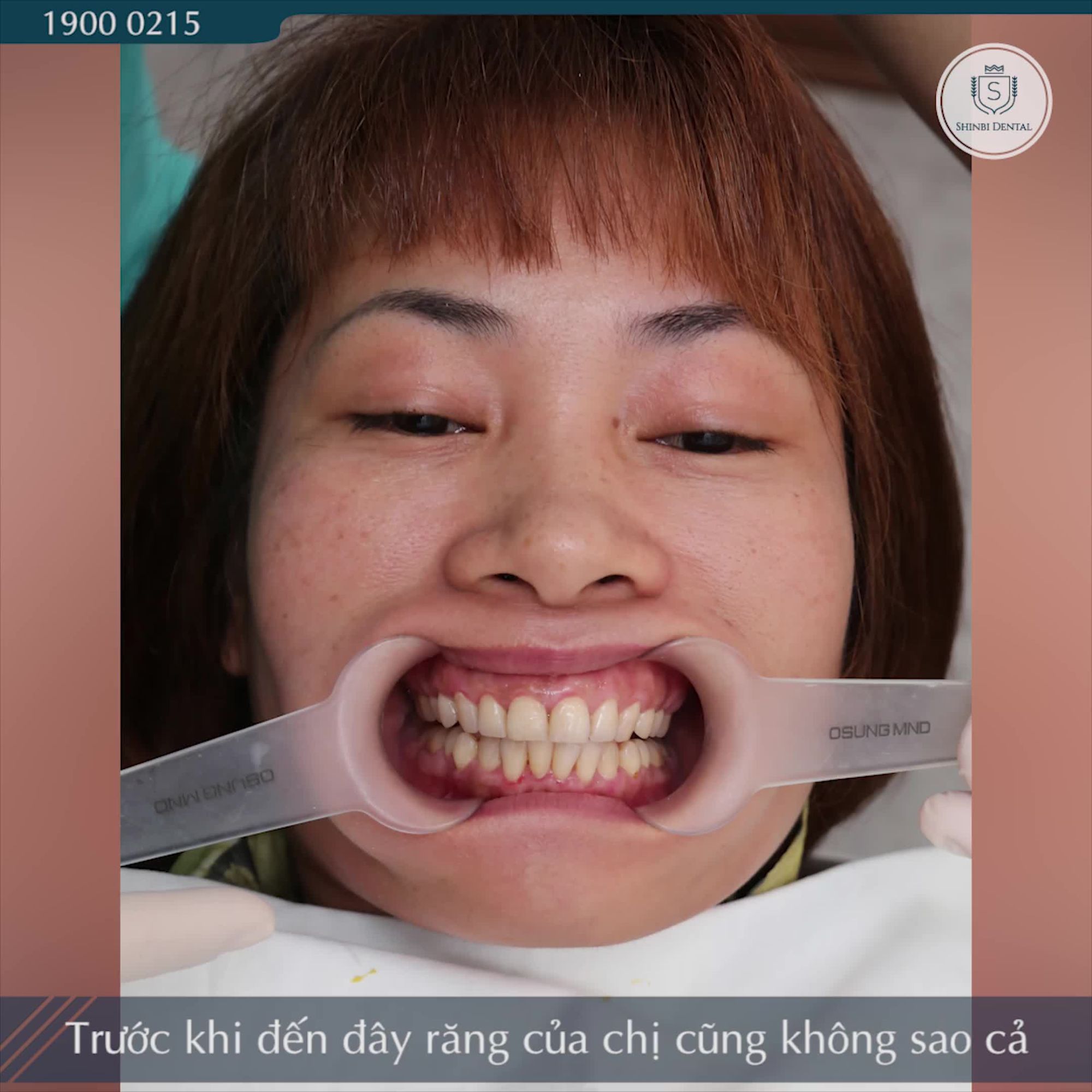 QUYẾT ĐỊNH ĐI DÁN RĂNG SỨ VÀ TÔI THẤY HOÀN TOÀN HÀI LÒNG